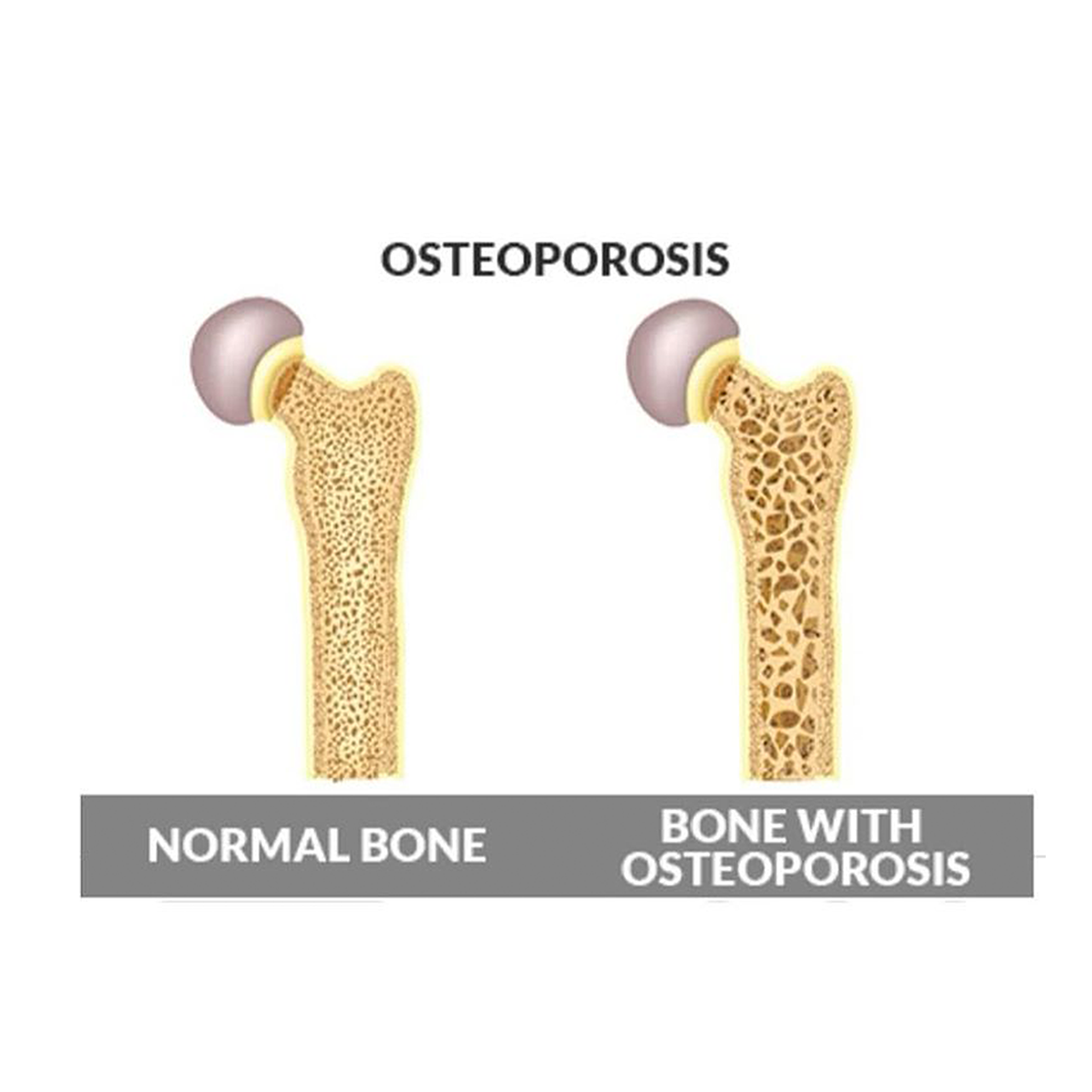 206 bones of the human body Osteoporosis Show Up Fitness LA Biology Diagrams